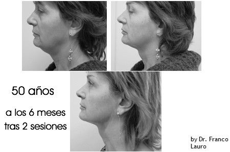 retensado piel con hifu