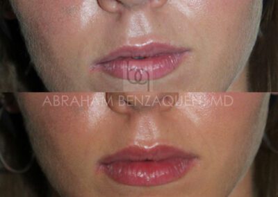 Antes y después relleno de labios - Caso 1 - Clínica Benzaquén Málaga