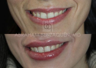 Antes y después relleno de labios - Caso 2 - Clínica Benzaquén Málaga