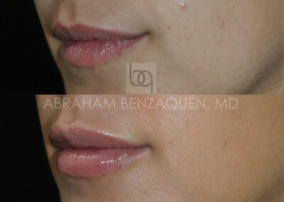Antes y después relleno de labios - Caso 3 - Clínica Benzaquén Málaga