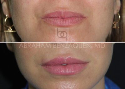 Antes y después relleno de labios - Caso 5 - Clínica Benzaquén Málaga