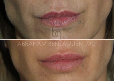 Antes y después relleno de labios - Caso 6 - Clínica Benzaquén Málaga