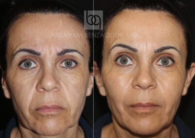 Foto Antes-y-despues-HIFU-BQ-caso-1-Clinica-Benzaquen-Malaga-