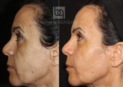 Foto Antes-y-despues-HIFU-BQ-caso-2-Clinica-Benzaquen-Malaga