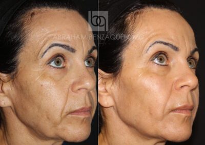 Foto Antes-y-despues-HIFU-BQ-caso-3-Clinica-Benzaquen-Malaga