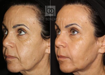 Foto Antes-y-despues-HIFU-BQ-caso-4-Clinica-Benzaquen-Malaga