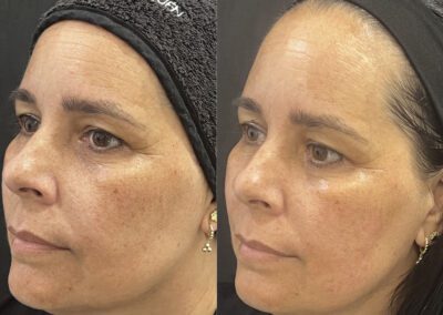 Antes y después de tratamiento HIFU facial en Málaga - Clínica Benzaquén