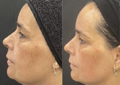 Antes y después de tratamiento HIFU facial en Málaga - Clínica Benzaquén