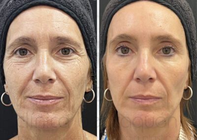 Antes y después de mesoterapia facial en Málaga - Clínica Benzaquén