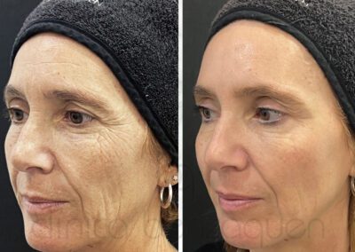 Antes y después de mesoterapia facial en Málaga - Clínica Benzaquén