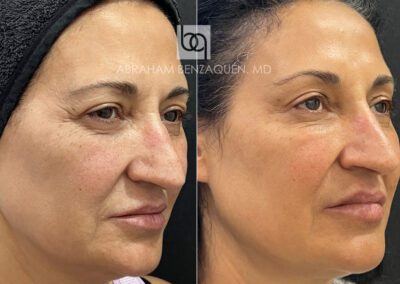 Antes y después de tratamiento HIFU facial en Málaga - Clínica Benzaquén