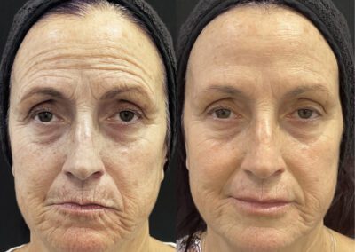 Antes y después de mesoterapia facial en Málaga - Clínica Benzaquén