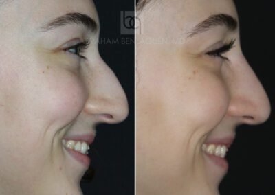 Antes y después de rinomodelación sin cirugía en Málaga - Clínica Benzaquén