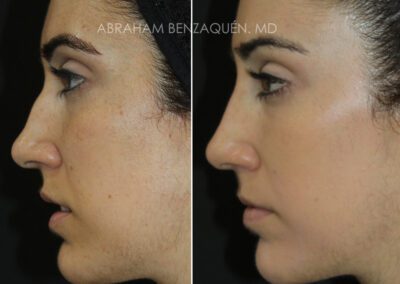 Antes y después de rinomodelación sin cirugía en Málaga - Clínica Benzaquén