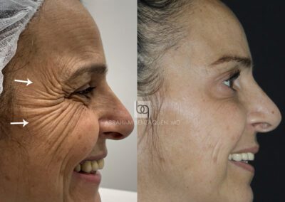 Tratamiento de antes y después para patas de gallo en Clínica Benzaquén