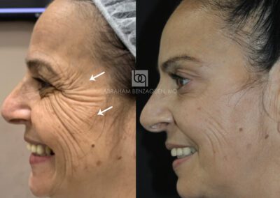 Antes y después , 1, Clínica Benzaquén Málaga