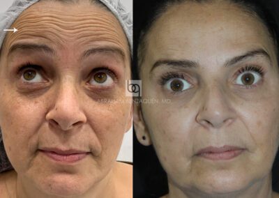Antes y después de arrugas de expresión en Clínica Benzaquén
