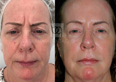 Antes y después de arrugas de expresión en Clínica Benzaquén