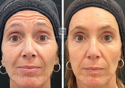 Antes y después de arrugas de expresión en Clínica Benzaquén